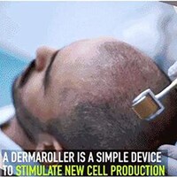 Picture of Hair Growth & Beard Growth Microneedle Dermaroller 540 Titanium Health